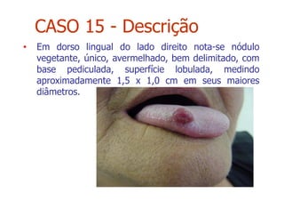 • Em dorso lingual do lado direito nota-se nódulo
vegetante, único, avermelhado, bem delimitado, com
base pediculada, superfície lobulada, medindo
aproximadamente 1,5 x 1,0 cm em seus maiores
diâmetros.
CASO 15 - Descrição
 