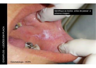 Estomatologia - HCPA
Identifique as lesões antes de passar a
próxima imagem
EXEMPLOS
–
LESÕES
EM
PLACA
 