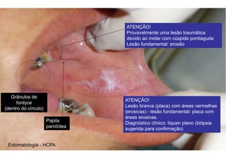 Estomatologia - HCPA
ATENÇÃO!
Provavelmente uma lesão traumática
devido ao molar com cúspide pontiaguda
Lesão fundamental: erosão
Grânulos de
fordyce
(dentro do círculo)
Papila
parotídea
ATENÇÃO!
Lesão branca (placa) com áreas vermelhas
(erosivas) - lesão fundamental: placa com
áreas erosivas.
Diagnóstico clínico: líquen plano (biópsia
sugerida para confirmação)
 