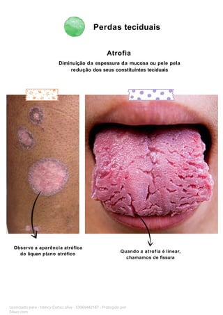 Perdas teciduais
Licenciado para - Isteicy Cortez silva - 33066442187 - Protegido por
Eduzz.com
Atrofia
Diminuição da espessura da mucosa ou pele pela
redução dos seus constituintes teciduais
Quando a atrofia é linear,
chamamos de fissura
Observe a aparência atrófica
do líquen plano atrófico
 