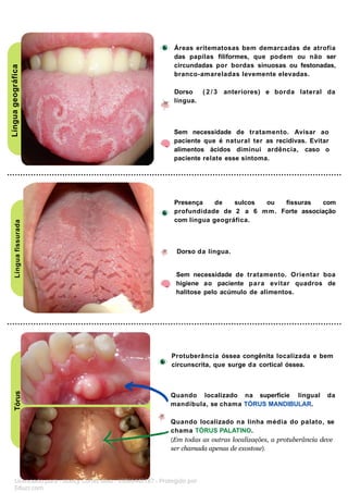 Língua
geográfica
Língua
fissurada
Tórus
Protuberância óssea congênita localizada e bem
circunscrita, que surge da cortical óssea.
Quando localizado na superfície lingual da
mandíbula, se chama TÓRUS MANDIBULAR.
Quando localizado na linha média do palato, se
chama TÓRUS PALATINO.
(Em todas as outras localizaęões, a protuberância deve
ser chamada apenas de exostose).
Áreas eritematosas bem demarcadas de atrofia
das papilas filiformes, que podem ou não ser
circundadas por bordas sinuosas ou festonadas,
branco-amareladas levemente elevadas.
Dorso ( 2 / 3 anteriores) e borda lateral da
língua.
Presença de sulcos ou fissuras com
profundidade de 2 a 6 mm. Forte associação
com língua geográfica.
Dorso da língua.
Sem necessidade de tratamento. Orientar boa
higiene ao paciente para evitar quadros de
halitose pelo acúmulo de alimentos.
Sem necessidade de tratamento. Avisar ao
paciente que é natural ter as recidivas. Evitar
alimentos ácidos diminui ardência, caso o
paciente relate esse sintoma.
Licenciado para - Isteicy Cortez silva - 33066442187 - Protegido por
Eduzz.com
 