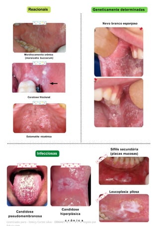 Estomatite nicotínica
Sífilis secundária
(placas mucosas)
Leucoplasia pilosa
Reacionais Geneticamente determinadas
Mordiscamento crônico
(morsicatio buccarum)
Ceratose friccional
Candidose
pseudomembranosa
Candidose
hiperplásica
Licenciado para - Isteicy Cortez silva - 330664421
c
8
r
7
ô
-
n
P
i
r
c
o
a
tegido por
Infecciosas
Nevo branco esponjoso
 