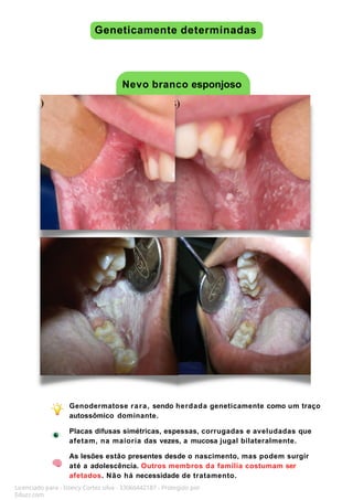 Geneticamente determinadas
Nevo branco esponjoso
Genodermatose rara, sendo herdada geneticamente como um traço
autossômico dominante.
Placas difusas simétricas, espessas, corrugadas e aveludadas que
afetam, na maioria das vezes, a mucosa jugal bilateralmente.
As lesões estão presentes desde o nascimento, mas podem surgir
até a adolescência. Outros membros da família costumam ser
afetados. Não há necessidade de tratamento.
Licenciado para - Isteicy Cortez silva - 33066442187 - Protegido por
Eduzz.com
 