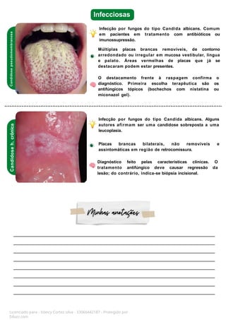 Candidose
h.
crônica
Candidose
pseudomembranosa
Infecciosas
Infecção por fungos do tipo Candida albicans. Comum
em pacientes em tratamento com antibióticos ou
imunossupressão.
Múltiplas placas brancas removíveis, de contorno
arredondado ou irregular em mucosa vestibular, língua
e palato. Áreas vermelhas de placas que já se
destacaram podem estar presentes.
O destacamento frente à raspagem confirma o
diagnóstico. Primeira escolha terapêutica são os
antifúngicos tópicos (bochechos com nistatina ou
miconazol gel).
Infecção por fungos do tipo Candida albicans. Alguns
autores afirmam ser uma candidose sobreposta a uma
leucoplasia.
Placas brancas bilaterais, não removíveis e
assintomáticas em região de retrocomissura.
Diagnóstico feito pelas características clínicas. O
tratamento antifúngico deve causar regressão da
lesão; do contrário, indica-se biópsia incisional.
Licenciado para - Isteicy Cortez silva - 33066442187 - Protegido por
Eduzz.com
 