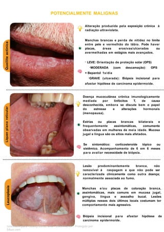 Queilite
actínica
Líquen
plano
reticular
POTENCIALMENTE MALIGNAS
Leucoplasia
Alteração produzida pela exposição crônica à
radiação ultravioleta.
Manchas brancas e perda de nitidez no limite
entre pele e vermelhão do lábio. Pode haver
placas, áreas erosivas/ulceradas ou
avermelhadas em estágios mais avançados.
- LEVE: Orientação de proteção solar (OPS)
-MODERADA (com descamação): OPS
+ Bepantol 1x/dia
-GRAVE (ulcerada): Biópsia incisional para
afastar hipótese de carcinoma epidermoide.
Doença mucocutânea crônica imunologicamente
mediada por linfócitos T, de causa
desconhecida, embora se discuta bem o papel
do estresse e alterações hormonais
(menopausa).
Estrias ou placas brancas bilaterais e
frequentemente assintomáticas, comumente
observadas em mulheres de meia idade. Mucosa
jugal e língua são os sítios mais afetados.
Se sintomático: corticosteroide tópico ou
sistêmico. Acompanhamento de 6 em 6 meses
para avaliar necessidade de biópsia.
Lesão predominantemente branca, não
removível à raspagem e que não pode ser
caracterizada clinicamente como outra doença;
normalmente associada ao fumo.
Manchas e/ou placas de coloração branca,
assintomáticas, mais comuns em mucosa jugal,
gengiva, língua e assoalho bucal. Lesões
múltiplas nesses dois últimos locais costumam ter
comportamento mais agressivo.
Biópsia incisional para afastar hipótese de
carcinoma epidermoide.
Licenciado para - Isteicy Cortez silva - 33066442187 - Protegido por
Eduzz.com
 