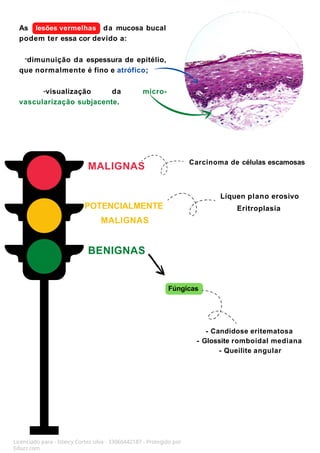 BENIGNAS
POTENCIALMENTE
MALIGNAS
MALIGNAS
Fúngicas
- Candidose eritematosa
- Glossite romboidal mediana
- Queilite angular
Carcinoma de células escamosas
As lesões vermelhas da mucosa bucal
podem ter essa cor devido a:
-dimunuição da espessura de epitélio,
que normalmente é fino e atrófico;
-visualização da micro-
vascularização subjacente.
Líquen plano erosivo
Eritroplasia
Licenciado para - Isteicy Cortez silva - 33066442187 - Protegido por
Eduzz.com
 