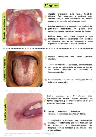 Candidose
eritemosa
Infecção provocada pelo fungo Candida
albicans.
Áreas vermelhas e atróficas, assintomáticas,
em região de linha média do dorso da língua.
De causa idiopática ou associada a
imunossupressão.
O tratamento consiste em antifúngicos tópicos
(Nistatina suspensão).
Glossite
r.
mediana
Queilite
angular Fúngicas
Licenciado para - Isteicy Cortez silva - 33066442187 - Protegido por
Eduzz.com
Infecção provocada pelo fungo Candida
albicans. Está associada a pacientes que
fizeram terapia com antibióticos de amplo
espectro, xerostomia ou imunossupressão.
Máculas vermelhas e sensação de queimação,
geralmente localizadas em palato duro
posterior, mucosa vestibular e dorso de língua.
Pode-se fazer uma prova terapêutica com
antifúngicos tópicos (bochechos com nistatina
ou miconazol gel): se for candidose, a lesão
regredirá. Do contrário, biópsia incisional.
Lesões causadas por C. albicans e/ou
Staphylococcus aureus. Podem aparecer de
forma idiopática, por imunossupressão, ou por
perda de dimensão vertical.
Lesões vermelhas fissuradas,
irritadas, localizadas na comissura labial.
O diagnóstico é baseado nas características
clínicas, e o tratamento pode ser feito com gel
de Miconazol. O reestabelecimento da
dimensão vertical também é importante para
evitar recidivas.
 