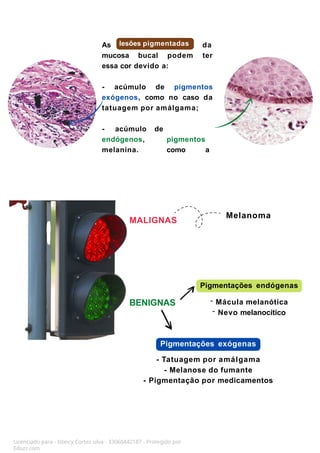 As da
mucosa bucal podem ter
essa cor devido a:
- acúmulo de pigmentos
exógenos, como no caso da
tatuagem por amálgama;
- acúmulo
endógenos,
melanina.
de
pigmentos
como a
BENIGNAS
MALIGNAS
Melanoma
lesões pigmentadas
Pigmentações endógenas
- Mácula melanótica
- Nevo melanocítico
Pigmentações exógenas
- Tatuagem por amálgama
- Melanose do fumante
- Pigmentação por medicamentos
Licenciado para - Isteicy Cortez silva - 33066442187 - Protegido por
Eduzz.com
 