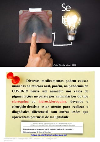 Diversos medicamentos podem causar
manchas na mucosa oral, porém, na pandemia de
COVID-19 houve um aumento nos casos de
pigmentações no palato por antimaláricos do tipo
cloroquina ou hidroxicloroquina, devendo o
cirurgião-dentista estar atento para realizar o
diagnóstico diferencial com outras lesões que
apresentam potencial de malignidade.
Licenciado para - Isteicy Cortez silva - 33066442187 - Protegido por
Eduzz.com
(clique na referência do artigo para ler)
Foto: Neville et al., 2016
Se
liga!
 