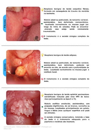 Fibroma
Lipoma
Papiloma
Neoplasia benigna de tecido conjuntivo fibroso,
formada em consequência do trauma da mordida
na bochecha.
Nódulo séssil ou pediculado, de tamanho variável,
assintomático, bem delimitado, normocrômico,
localizado normalmente na mucosa jugal (ao
longo da linha de oclusão). Pode se encontrar
ulcerado caso esteja sendo cronicamente
traumatizado.
O tratamento é a excisão cirúrgica completa da
lesão.
Neoplasia benigna de tecido adiposo.
Licenciado para - Isteicy Cortez silva - 33066442187 - Protegido por
Eduzz.com
Nódulo séssil ou pediculado, de tamanho variável,
assintomático, bem delimitado, podendo ser
amarelo ou não, de acordo com a profundidade da
lesão. Localizado normalmente na mucosa jugal e
vestíbulo bucal.
O tratamento é a excisão cirúrgica completa da
lesão.
Neoplasia benigna de tecido epitelial pavimentoso
estratificado induzida pelo vírus HPV de baixo
risco (principalmente os tipos 6 e 11).
Nódulo exofítico amolecido, assintomático, com
projeções digitiformes, de cor branca, vermelha ou
da mucosa. Localizados principalmente em palato,
língua e lábios (mas qualquer superfície oral pode
ser afetada).
A excisão cirúrgica conservadora, incluindo a base
da lesão é o tratamento adequado para o
papiloma e recidivas são incomuns.
 
