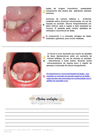 Mucocele
Rânula
Lesão de origem traumática, ocasionando
rompimento dos ductos das glândulas salivares
menores.
Aumento de volume bolhoso e brilhante
contendo saliva (mucina) extravasada, da cor da
mucosa ou azulado. Ocorre frequentemente em
lábio inferior, pois a região é mais suscetível ao
trauma. O paciente pode relatar episódios de
remissão e recorrência da lesão.
O tratamento é a remoção cirúrgica da lesão,
incluindo a glândula, para evitar recidivas.
A rânula é uma mucocele que ocorre no assoalho
de boca. Apresenta-se como um aumento de
volume brilhoso, da cor da mucosa ou azulado,
lateralmente à linha média. Quando ocorre
extravasamento de mucina para a região do
pescoço, é chamada de rânula mergulhante.
O tratamento é a marsupialização da lesão, que
consiste na remoção da porção superior da lesão,
cujas bordas são suturadas em continuidade com o
epitélio do assoalho oral.
Licenciado para - Isteicy Cortez silva - 33066442187 - Protegido por
Eduzz.com
 
