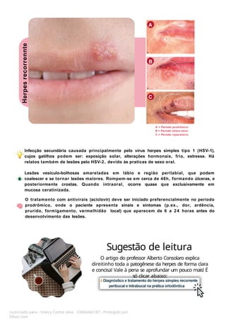 C
Infecção secundária causada principalmente pelo vírus herpes simples tipo 1 (HSV-1),
cujos gatilhos podem ser: exposição solar, alterações hormonais, frio, estresse. Há
relatos também de lesões pelo HSV-2, devido às praticas de sexo oral.
Lesões vesiculo-bolhosas amareladas em lábio e região perilabial, que podem
coalescer e se tornar lesões maiores. Rompem-se em cerca de 48h, formando úlceras, e
posteriormente crostas. Quando intraoral, ocorre quase que exclusivamente em
mucosa ceratinizada.
O tratamento com antivirais (aciclovir) deve ser iniciado preferencialmente no período
prodrômico, onde o paciente apresenta sinais e sintomas (p.ex., dor, ardência,
prurido, formigamento, vermelhidão local) que aparecem de 6 a 24 horas antes do
desenvolvimento das lesões.
Licenciado para - Isteicy Cortez silva - 33066442187 - Protegido por
Eduzz.com
Herpes
recorrennte A
B
A = Período prodrômico
B = Período clínico ativo
C = Período reparatório
Sugestão de leitura
O artigo do professor Alberto Consolaro explica
direitinho toda a patogênese da herpes de forma clara
e concisa! Vale à pena se aprofundar um pouco mais! É
só clicar abaixo:
 