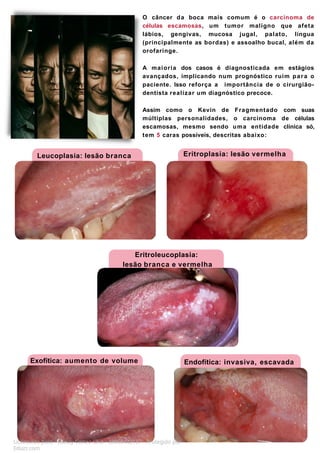 O câncer da boca mais comum é o carcinoma de
células escamosas, um tumor maligno que afeta
lábios, gengivas, mucosa jugal, palato, língua
(principalmente as bordas) e assoalho bucal, além da
orofaringe.
A maioria dos casos é diagnosticada em estágios
avançados, implicando num prognóstico ruim para o
paciente. Isso reforça a importância de o cirurgião-
dentista realizar um diagnóstico precoce.
Assim como o Kevin de Fragmentado com suas
múltiplas personalidades, o carcinoma de células
escamosas, mesmo sendo uma entidade clínica só,
tem 5 caras possíveis, descritas abaixo:
Licenciado para - Isteicy Cortez silva - 33066442187 - Protegido por
Eduzz.com
Leucoplasia: lesão branca Eritroplasia: lesão vermelha
Eritroleucoplasia:
lesão branca e vermelha
Exofítica: aumento de volume Endofítica: invasiva, escavada
 