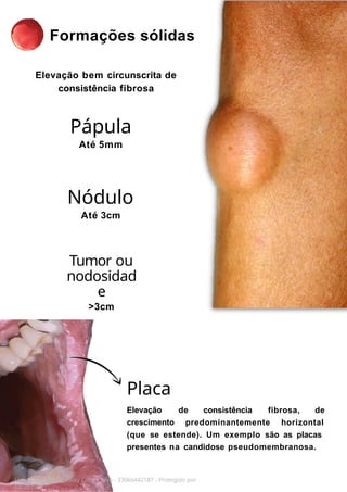 Formações sólidas
Elevação bem circunscrita de
consistência fibrosa
Licenciado para - Isteicy Cortez silva - 33066442187 - Protegido por
Eduzz.com
Pápula
Até 5mm
Nódulo
Até 3cm
Tumor ou
nodosidad
e
>3cm
de consistência fibrosa, de
Placa
Elevação
crescimento predominantemente horizontal
(que se estende). Um exemplo são as placas
presentes na candidose pseudomembranosa.
 