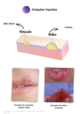 Coleções líquidas
Licenciado para - Isteicy Cortez silva - 33066442187 - Protegido por
Eduzz.com
Até 3mm
>3mm
Exemplo de vesículas:
herpes labial
Exemplo de bolha:
mucocele
 