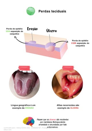 Repare que as úlceras são recobertas
por membrana fibrinopurulenta
amarelada e circundadas por halo
eritematoso.
Perdas teciduais
Licenciado para - Isteicy Cortez silva - 33066442187 - Protegido por
Eduzz.com
Perda de epitélio
SEM exposição do
conjuntivo
Perda de epitélio
COM exposição do
conjuntivo
Língua geográfica é um
exemplo de EROSÃO
Aftas recorrentes são
exemplo de ÚLCERA
 