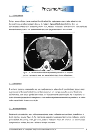 2.2 – Cistos tímicos


Podem ser congênitos (raros) ou adquiridos. Os adquiridos podem estar relacionados a toracotomia,
tumores tímicos e radioterapia para doença de Hodgkin. A possibilidade de cisto tímico deve ser
considerada quando a lesão apresenta paredes finas, não está associada a lesão expansiva e seu conteúdo
tem densidade líquida ou não apresenta realce após a injeção intravenosa de contraste.




                   Figura 2. TC de tórax evidenciando múltiplas formações císticas na topografia
                       do timo, com paredes finas, sem realce (setas). Cistos tímicos linfoepiteliais.




2.3 – Timolipoma


É um tumor benigno, encapsulado, que não invade estruturas adjacentes. É constituído por gordura e por
quantidades variáveis de tecido tímico, sendo mais comum em crianças e adultos jovens. Geralmente
assintomático, pode atingir grandes dimensões, por vezes simulando cardiomegalia. Na TC apresenta-se
como uma formação expansiva na loja tímica com densidade predominantemente de gordura ou de partes
moles, dependendo da sua composição.




2.4 – Massas tiroidianas


Geralmente correspondem a um bócio que se estende para o mediastino, apresentando conexão com o
tecido tiroidiano cervical (figura 3). Na maioria dos casos tais massas se encontram no mediastino anterior
(cerca de 80% das vezes), porém, por vezes, estão no mediastino médio. Os sintomas são relacionados à
compressão do esôfago, traquéia e do nervo laríngeo recorrente.



Curso Pneumo Atual de Tomografia computadorizada do tórax – aula 09                                           2
 