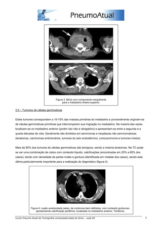 Figura 3. Bócio com componente mergulhante
                                       para o mediastino Antero-superior.


2.5 – Tumores de células germinativas


Estes tumores correspondem a 10-15% das massas primárias do mediastino e provavelmente originam-se
de células germinativas primitivas que interromperam sua migração no mediastino. Na maioria das vezes
localizam-se no mediastino anterior (porém isto não é obrigatório) e apresentam-se entre a segunda e a
quarta décadas de vida. Geralmente são divididos em seminomas e neoplasias não seminomatosas
(teratomas, carcinomas embrionários, tumores do seio endodérmico, coriocarcinoma e tumores mistos).


Mais de 80% dos tumores de células germinativas são benignos, sendo a maioria teratomas. Na TC pode-
se ver uma combinação de cistos com conteúdo líquido, calcificações (encontradas em 20% a 80% dos
casos), tecido com densidade de partes moles e gordura (identificada em metade dos casos), sendo esta
última particularmente importante para a realização do diagnóstico (figura 4).




            Figura 4. Lesão arredondada (seta), de contornos bem definidos, com conteúdo gorduroso,
                apresentando calcificação periférica, localizada no mediastino anterior. Teratoma.

Curso Pneumo Atual de Tomografia computadorizada do tórax – aula 09                                      3
 
