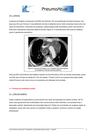 2.6 – Linfomas


A doença de Hodgkin corresponde a 20-40% dos linfomas. Há uma distribuição bimodal da doença, com
picos aos 30 e aos 70 anos. O acometimento do tórax é bastante comum tanto na doença inicial como nos
casos de recorrência. Linfonodos em quaisquer cadeias podem estar acometidos, porém comumente os
linfonodos mediastinais superiores estão envolvidos (figura 5). O acometimento hilar pode ser bilateral,
porém é geralmente assimétrico.




                           Figura 5. Doença de Hodgkin com múltiplas linfonodomegalias
                                      no mediastino e derrame pleural bilateral.


Cerca de 60% dos linfomas não-Hodgkin originam-se nos linfonodos e 40% em tecidos extranodais, sendo
que 85% são oriundos de células B e 15% de células T. Podem ocorrer em qualquer faixa etária (idade
média 50 anos) e são mais comuns em pacientes com alteração da imunidade.




3 – Tumores do mediastino médio


3.1 – Cisto broncogênico


Lesão congênita correspondendo a cerca de 60% dos cistos de duplicação do intestino anterior. Na TC
estes cistos geralmente são arredondados, têm contornos lisos e bem definidos, com paredes finas e
atenuação variável, dependendo da composição (figura 6). Podem ser encontrados em qualquer região do
mediastino, porém são mais comuns no mediastino médio e posterior, próximos à carina e na região
paratraqueal.




Curso Pneumo Atual de Tomografia computadorizada do tórax – aula 09                                        4
 