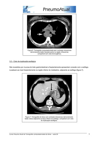 Figura 6. Tomografia computadorizada sem contraste intravenoso
                             demonstrando lesão hipoatenuante na região infracarinal,
                                       compatível com cisto broncogênico.




3.2 – Cisto de duplicação esofágica


São revestidos por mucosa do trato gastrointestinal e freqüentemente apresentam conexão com o esôfago.
Localizam-se mais freqüentemente na região inferior do mediastino, adjacente ao esôfago (figura 7).




                      Figura 7. Tomografia do tórax com contraste intravenoso demonstrando
                     lesão cística adjacente ao terço inferior do esôfago, compatível com cisto
                                              de duplicação esofágica.




Curso Pneumo Atual de Tomografia computadorizada do tórax – aula 09                                      5
 