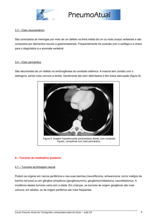 3.3 – Cisto neuroentérico


São conectados às meninges por meio de um defeito na linha média de um ou mais corpos vertebrais e são
compostos por elementos neurais e gastrointestinais. Freqüentemente há conexão com o esôfago e a chave
para o diagnóstico é a anomalia vertebral.




3.4 – Cisto pericárdico


São decorrentes de um defeito na embriogênese da cavidade celômica. A maioria tem contato com o
diafragma, sendo mais comuns à direita. Geralmente são bem delimitados e têm baixa atenuação (figura 8).




                          Figura 8. Imagem hipoatenuante paracardíaca direita, com conteúdo
                                       líquido, compatível com cisto pericárdico.




4 – Tumores do mediastino posterior


4.1 – Tumores de linhagem neural


Podem se originar em nervos periféricos e nas suas bainhas (neurofibroma, schwannoma, tumor maligno da
bainha nervosa) ou em gânglios simpáticos (ganglioneuroma, ganglioneuroblastoma, neuroblastoma). A
incidência destes tumores varia com a idade. Em crianças, os tumores de origem ganglionar são mais
comuns; em adultos, os de origem periférica são mais freqüentes.




Curso Pneumo Atual de Tomografia computadorizada do tórax – aula 09                                    6
 
