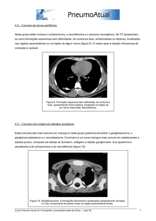 4.2 – Tumores de nervos periféricos


Neste grupo estão inclusos o schwannoma, o neurofibroma e o sarcoma neurogênico. Na TC apresentam-
se como formações expansivas bem delimitadas, de contornos lisos, arredondadas ou elípticas, localizadas
nas regiões paravertebrais ou no trajeto de algum nervo (figura 9). O realce após a injeção intravenosa de
contraste é variável.




                           Figura 9. Formação expansiva bem delimitada, de contornos
                            lisos, apresentando forma elíptica, localizada no trajeto de
                                        um nervo intercostal. Neurofibroma.




4.2 – Tumores com origem em gânglios simpáticos


Estes tumores são mais comuns em crianças e neste grupo podemos encontrar o ganglioneuroma, o
ganglioneuroblastoma e o neuroblastoma. O primeiro é um tumor benigno mais comum em adolescentes e
adultos jovens, composto de células de Schwann, colágeno e células ganglionares. Sua aparência é
semelhante à do schwannoma e do neurofibroma (figura 10).




             Figura 10. Ganglioneuroma. A tomografia demonstra a localização extrapulmonar da lesão
                        e o seu componente de partes moles na região paravertebral direita.

Curso Pneumo Atual de Tomografia computadorizada do tórax – aula 09                                          7
 