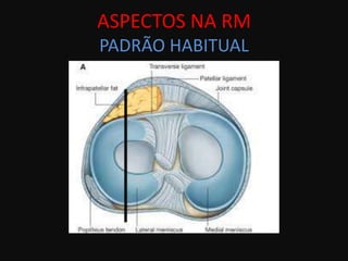 ASPECTOS NA RM
PADRÃO HABITUAL
 