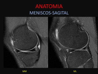 ANATOMIA
          MENISCOS-SAGITAL




MM
     MM                      ML
 