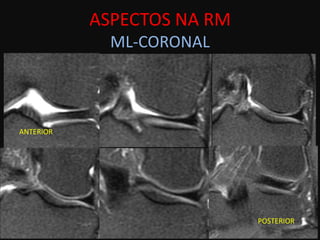 ASPECTOS NA RM
             ML-CORONAL



ANTERIOR




                            POSTERIOR
 