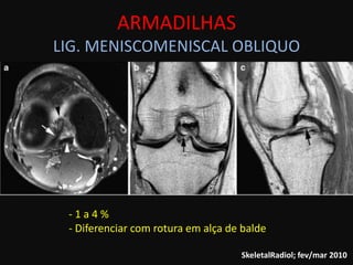 ARMADILHAS
LIG. MENISCOMENISCAL OBLIQUO




 -1a4%
 - Diferenciar com rotura em alça de balde

                                    SkeletalRadiol; fev/mar 2010
 