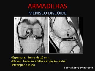 ARMADILHAS
              MENISCO DISCÓIDE




- Espessura mínima de 15 mm
- Ele resulta de uma falha na porção central
- Predispõe a lesão
                                          SkeletalRadiol; fev/mar 2010
 
