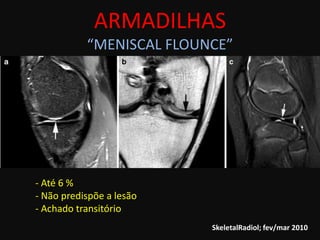 ARMADILHAS
           “MENISCAL FLOUNCE”




- Até 6 %
- Não predispõe a lesão
- Achado transitório
                          SkeletalRadiol; fev/mar 2010
 