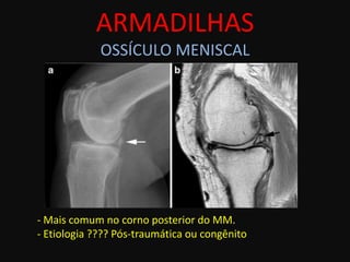 ARMADILHAS
             OSSÍCULO MENISCAL




- Mais comum no corno posterior do MM.
- Etiologia ???? Pós-traumática ou congênito
 