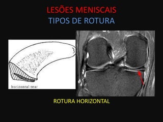LESÕES MENISCAIS
TIPOS DE ROTURA




 ROTURA HORIZONTAL
 