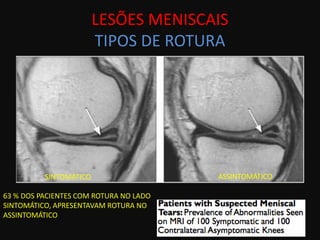 LESÕES MENISCAIS
                        TIPOS DE ROTURA




          SINTOMÁTICO                   ASSINTOMÁTICO

63 % DOS PACIENTES COM ROTURA NO LADO
SINTOMÁTICO, APRESENTAVAM ROTURA NO
ASSINTOMÁTICO
 