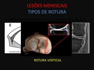 LESÕES MENISCAIS
           TIPOS DE ROTURA
• http://www.radsource.us/_images/0208_6.jp
  g




               ROTURA VERTICAL
 