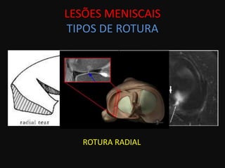 LESÕES MENISCAIS
TIPOS DE ROTURA




   ROTURA RADIAL
 