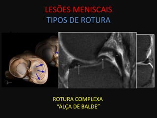 LESÕES MENISCAIS
      TIPOS DE ROTURA
• v




       ROTURA COMPLEXA
        “ALÇA DE BALDE”
 