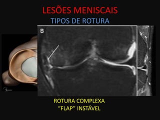 LESÕES MENISCAIS
 TIPOS DE ROTURA




  ROTURA COMPLEXA
   “FLAP” INSTÁVEL
 