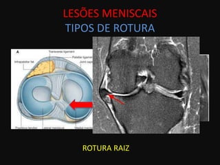 LESÕES MENISCAIS
TIPOS DE ROTURA




   ROTURA RAIZ
 