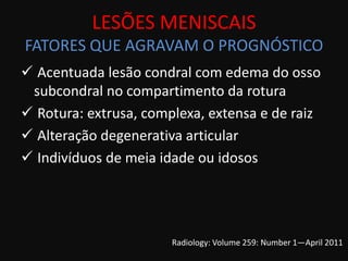 LESÕES MENISCAIS
FATORES QUE AGRAVAM O PROGNÓSTICO
 Acentuada lesão condral com edema do osso
 subcondral no compartimento da rotura
 Rotura: extrusa, complexa, extensa e de raiz
 Alteração degenerativa articular
 Indivíduos de meia idade ou idosos




                       Radiology: Volume 259: Number 1—April 2011
 