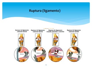 Ruptura	
  (ligamento)	
  
10	
  
 