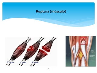 11	
  
Ruptura	
  (músculo)	
  	
  
 