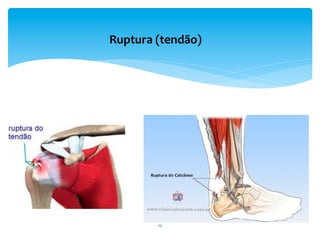12	
  
Ruptura	
  (tendão)	
  	
  
 