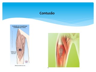 14	
  
Contusão	
  
 