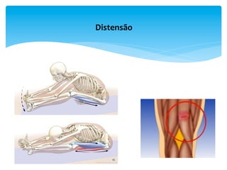 16	
  
Distensão	
  
 