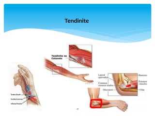 18	
  
Tendinite	
  
 