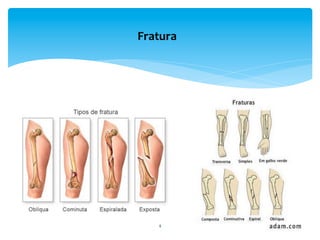 4	
  
Fratura	
  
 