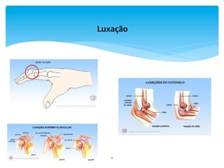 6	
  
Luxação	
  	
  
 