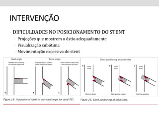 INTERVENÇÃO 
• DIFICULDADES NO POSICIONAMENTO DO STENT 
• Projeções que mostrem o óstio adequadamente 
• Visualização subótima 
• Movimentação excessiva do stent 
 